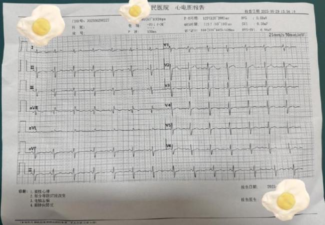 戴手表竟然被雷劈了！